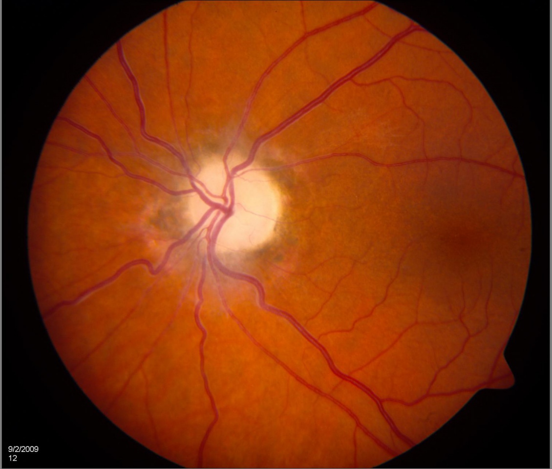Optic Neuropathy